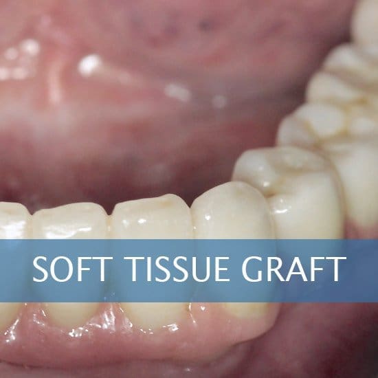 Soft Tissue Graft